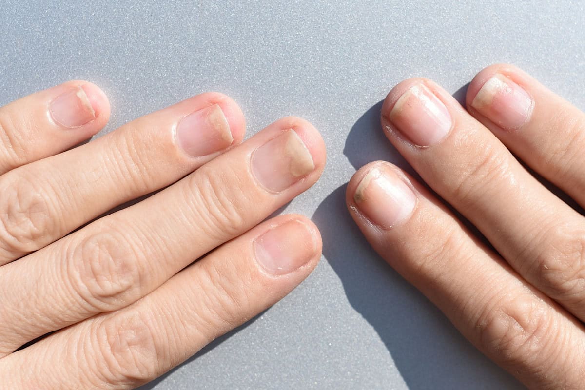 Tách móng là tình trạng móng tay hoặc móng chân bị tách rời khỏi lớp da bên dưới (giường móng)