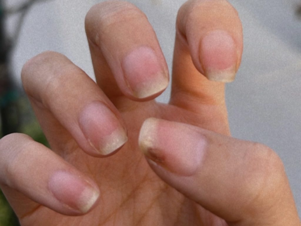 Tùy vào vị trí móng bắt đầu tách khỏi da, bong móng được chia thành các loại khác nhau