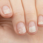 Nguyên nhân gây tách móng có thể xuất phát từ tác động tại chỗ hoặc các vấn đề sức khỏe