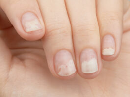 Những điều cần biết về chứng tách móng (bong móng): Nguyên nhân, dấu hiệu và cách điều trị hiệu quả Nguyên nhân gây tách móng có thể xuất phát từ tác động tại chỗ hoặc các vấn đề sức khỏe