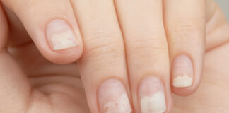 Nguyên nhân gây tách móng có thể xuất phát từ tác động tại chỗ hoặc các vấn đề sức khỏe