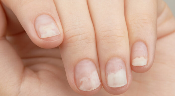 Những điều cần biết về chứng tách móng (bong móng): Nguyên nhân, dấu hiệu và cách điều trị hiệu quả Nguyên nhân gây tách móng có thể xuất phát từ tác động tại chỗ hoặc các vấn đề sức khỏe