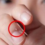 Xước măng rô: Nguyên nhân và cách điều trị đúng để da quanh móng luôn khỏe mạnh Xước măng rô