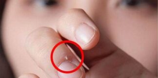 Xước măng rô: Nguyên nhân và cách điều trị đúng để da quanh móng luôn khỏe mạnh Xước măng rô