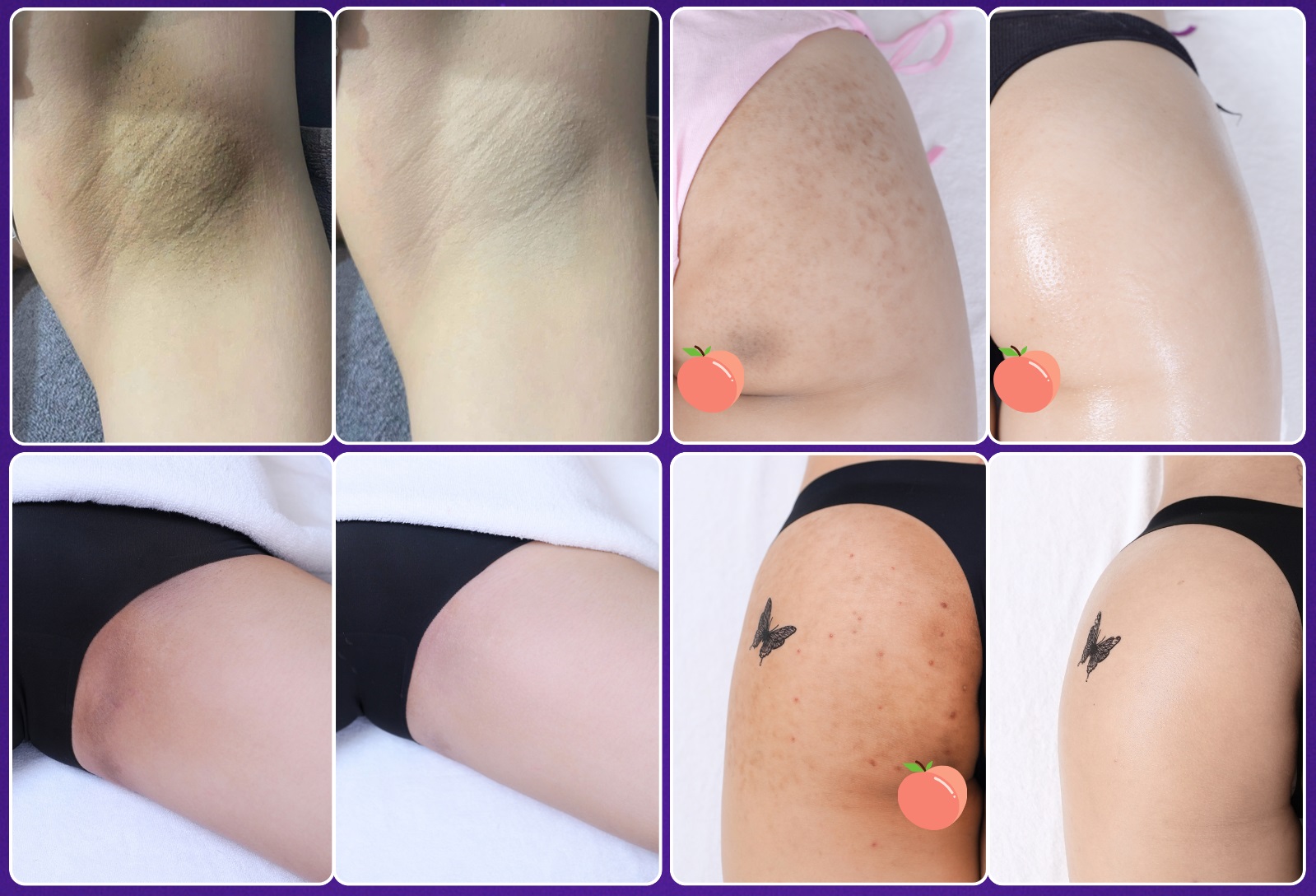 Kết quả liệu trình trị thâm body tại LG Clinic