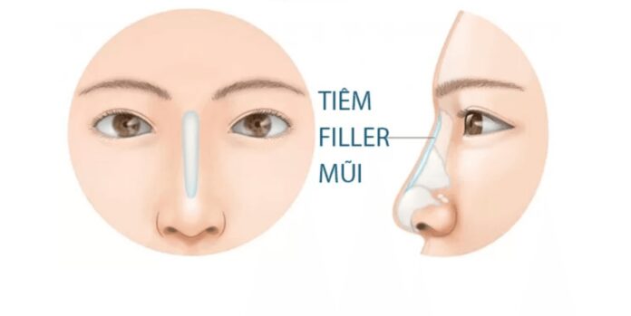 Tại sao nhiều người chọn tiêm filler mũi?