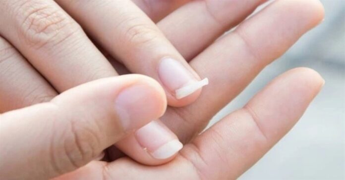 Móng mỏng, yếu, dễ gãy