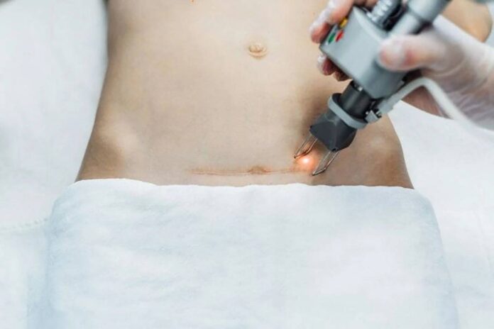 Liệu pháp laser