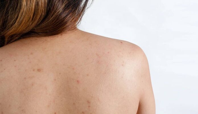 Việc tự cắt mụn thịt có thể gây chảy máu, nhiễm trùng hoặc để lại sẹo nếu dụng cụ không được vô trùng đúng cách
