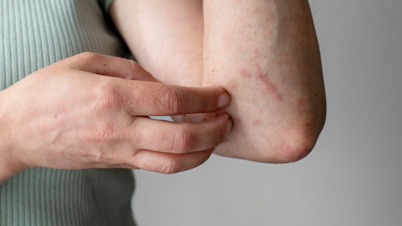Dùng quá nhiều biotin có thể gây phát ban